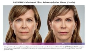 Juvederm Before and After Pictures in Middletown, NJ