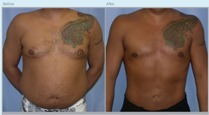 Liposuction Austin