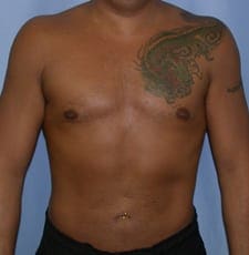 Liposuction Before and After Pictures in Middletown and Red Bank, NJ