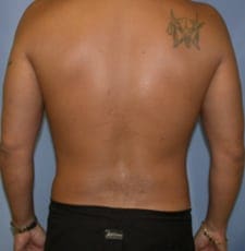 Liposuction Before and After Pictures in Middletown and Red Bank, NJ