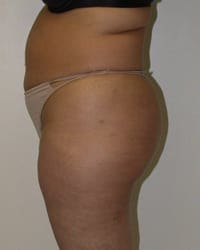 Liposuction Before and After Pictures in Middletown and Red Bank, NJ