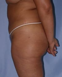 Liposuction Before and After Pictures in Middletown and Red Bank, NJ