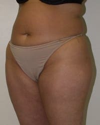 Liposuction Before and After Pictures in Middletown and Red Bank, NJ