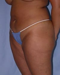 Liposuction Before and After Pictures in Middletown and Red Bank, NJ