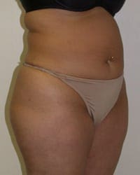 Liposuction Before and After Pictures in Middletown and Red Bank, NJ