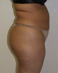 Liposuction Before and After Pictures in Middletown and Red Bank, NJ