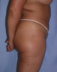 Liposuction Before and After Pictures in Middletown and Red Bank, NJ