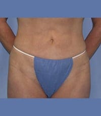 Liposuction Before and After Pictures in Middletown and Red Bank, NJ