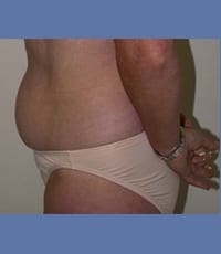 Liposuction Before and After Pictures in Middletown and Red Bank, NJ