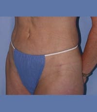 Liposuction Before and After Pictures in Middletown and Red Bank, NJ