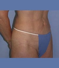 Liposuction Before and After Pictures in Middletown and Red Bank, NJ