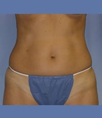 Liposuction Before and After Pictures in Middletown and Red Bank, NJ