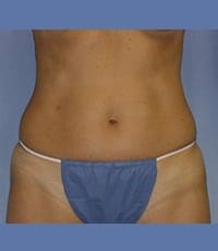 Liposuction Before and After Pictures in Middletown and Red Bank, NJ