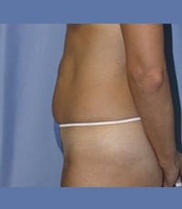 Liposuction Before and After Pictures in Middletown and Red Bank, NJ