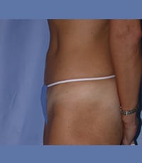 Liposuction Before and After Pictures in Middletown and Red Bank, NJ