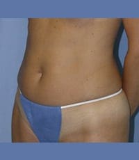 Liposuction Before and After Pictures in Middletown and Red Bank, NJ