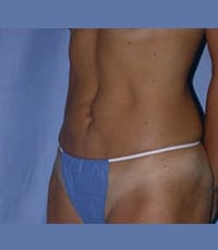 Liposuction Before and After Pictures in Middletown and Red Bank, NJ