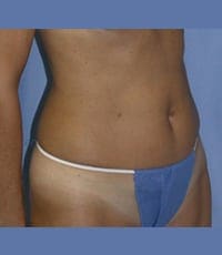 Liposuction Before and After Pictures in Middletown and Red Bank, NJ