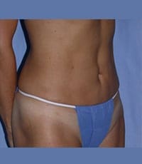 Liposuction Before and After Pictures in Middletown and Red Bank, NJ