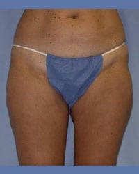 Liposuction Before and After Pictures in Middletown and Red Bank, NJ