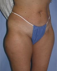 Liposuction Before and After Pictures in Middletown and Red Bank, NJ