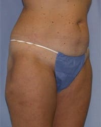 Liposuction Before and After Pictures in Middletown and Red Bank, NJ