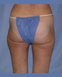 Liposuction Before and After Pictures in Middletown and Red Bank, NJ