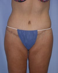 Body Lift Before and After Pictures in Middletown and Red Bank, NJ