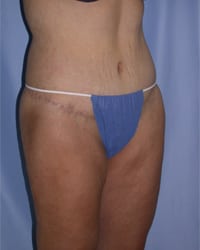 Body Lift Before and After Pictures in Middletown and Red Bank, NJ