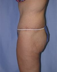 Body Lift Before and After Pictures in Middletown and Red Bank, NJ