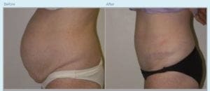 Tummy Tuck in Middletown, NJ