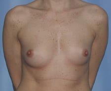 Breast Reconstruction Before and After Pictures in Middletown and Red Bank, NJ