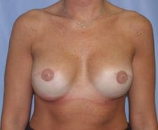 Breast Reconstruction Before and After Pictures in Middletown and Red Bank, NJ