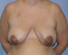 Breast Reconstruction Before and After Pictures in Middletown and Red Bank, NJ