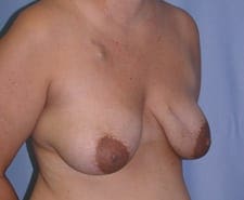 Breast Reconstruction Before and After Pictures in Middletown and Red Bank, NJ