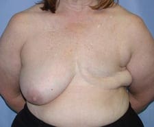 Breast Reconstruction Before and After Pictures in Middletown and Red Bank, NJ