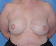 Breast Reconstruction Before and After Pictures in Middletown and Red Bank, NJ