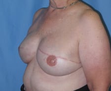 Breast Reconstruction Before and After Pictures in Middletown and Red Bank, NJ