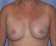 Breast Reconstruction Before and After Pictures in Middletown and Red Bank, NJ