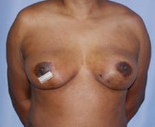 Breast Reconstruction Before and After Pictures in Middletown and Red Bank, NJ
