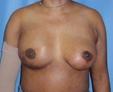 Breast Reconstruction Before and After Pictures in Middletown and Red Bank, NJ