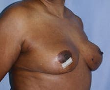 Breast Reconstruction Before and After Pictures in Middletown and Red Bank, NJ