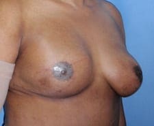 Breast Reconstruction Before and After Pictures in Middletown and Red Bank, NJ