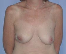 Breast Reconstruction Before and After Pictures in Middletown and Red Bank, NJ