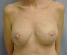 Breast Reconstruction Before and After Pictures in Middletown and Red Bank, NJ