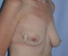 Breast Reconstruction Before and After Pictures in Middletown and Red Bank, NJ