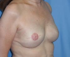 Breast Reconstruction Before and After Pictures in Middletown and Red Bank, NJ