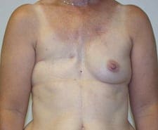 Breast Reconstruction Before and After Pictures in Middletown and Red Bank, NJ