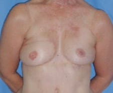 Breast Reconstruction Before and After Pictures in Middletown and Red Bank, NJ