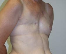 Breast Reconstruction Before and After Pictures in Middletown and Red Bank, NJ